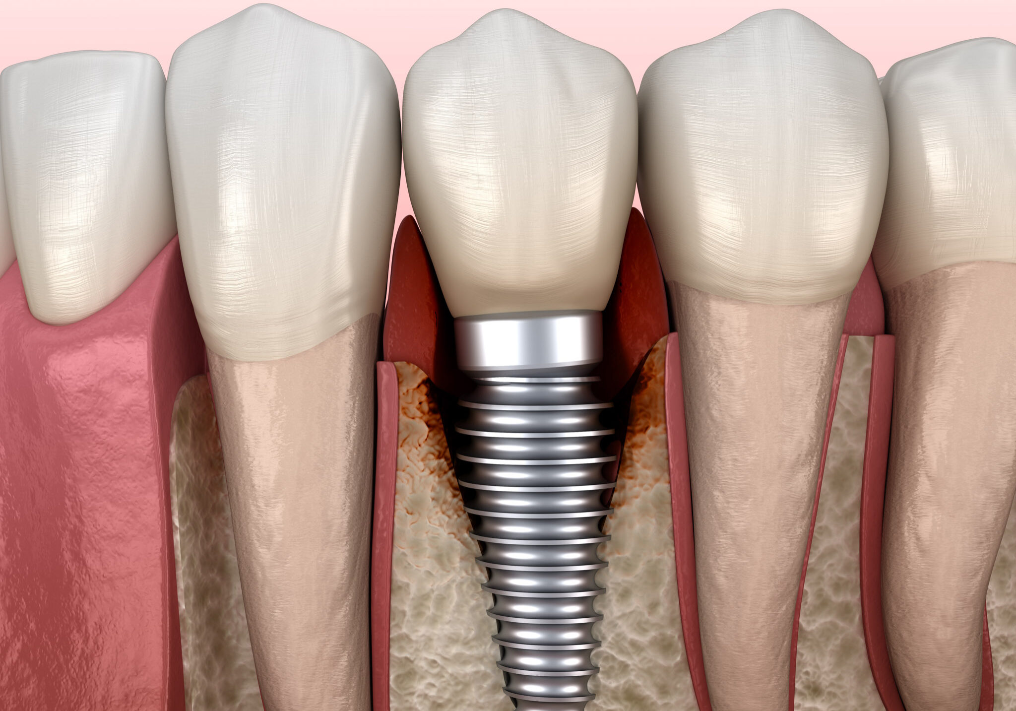 Periimplantitis with visible bone damage. Medically accurate 3D illustration of dental implants concept
